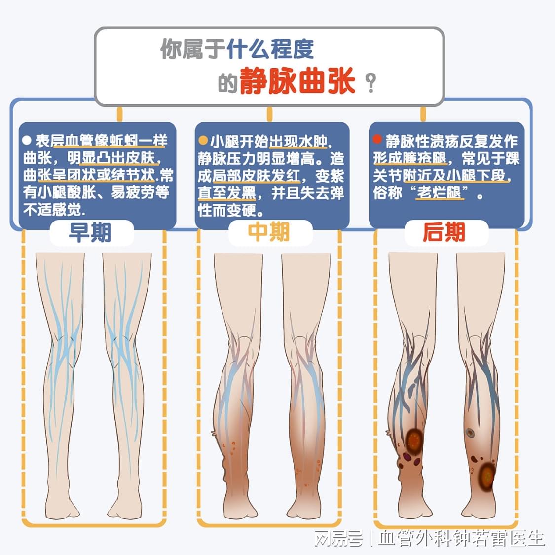 靜脈曲張最新療法，科技引領(lǐng)健康之路的新突破